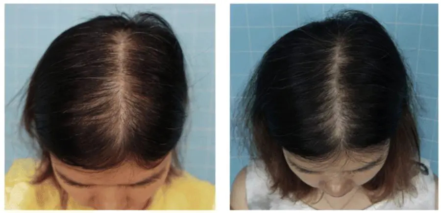Topical Minoxidil and hair growth: clinical photos in female pattern hair loss patient