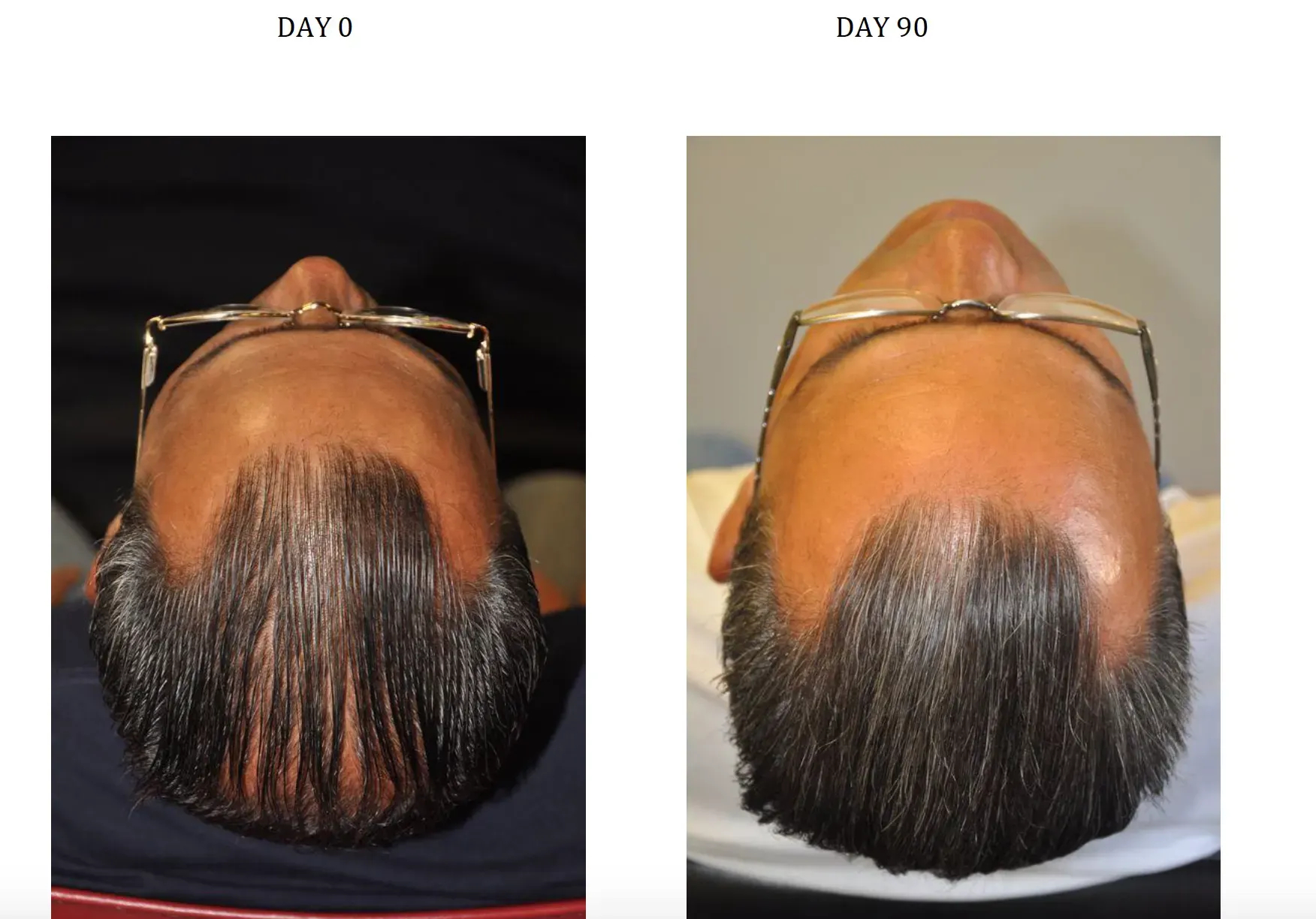 Before and after photos of taking Nanoxidil for 90 days to promote hair growth
