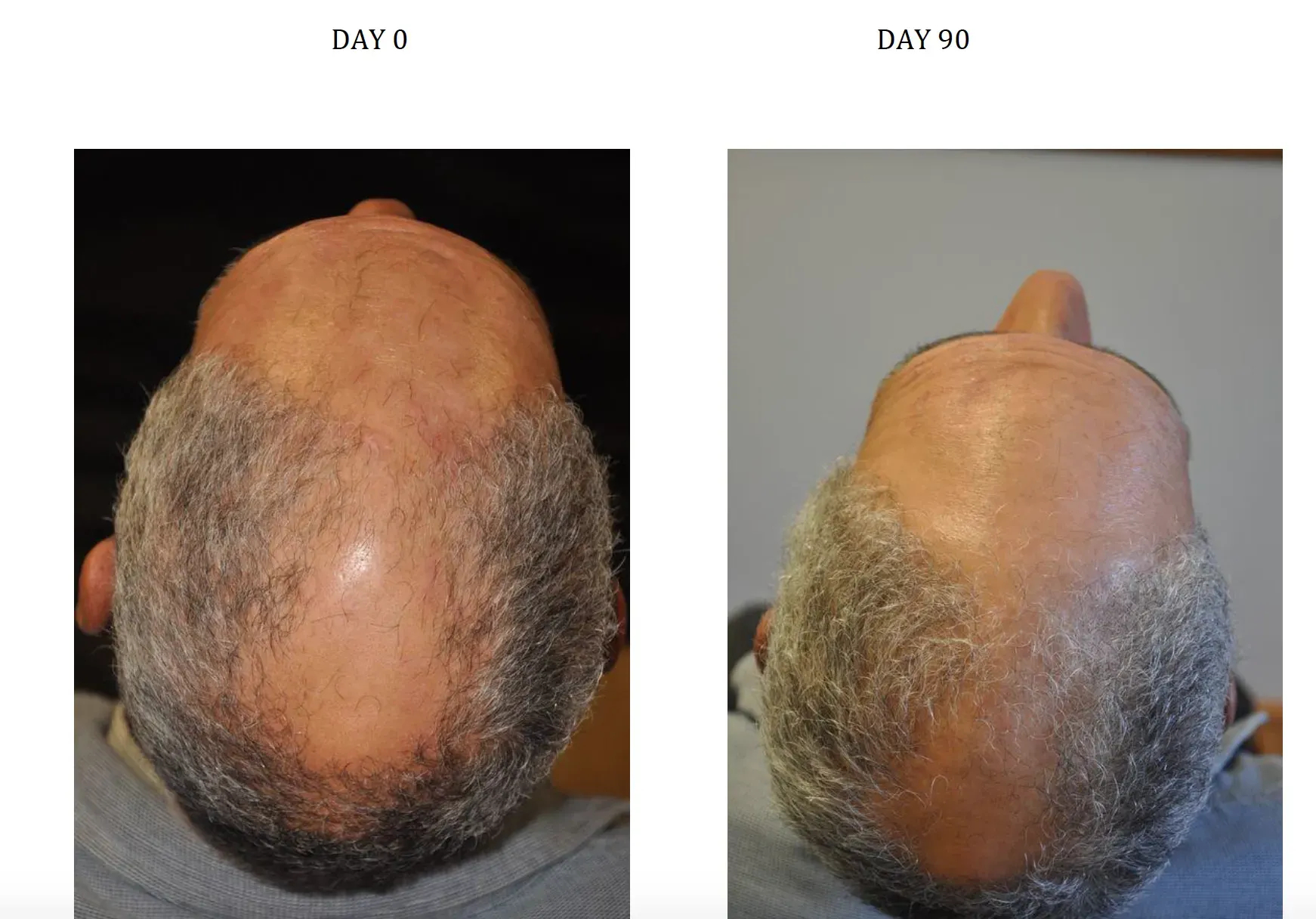 Before and after photos of taking Nanoxidil in a male pattern hair loss patient