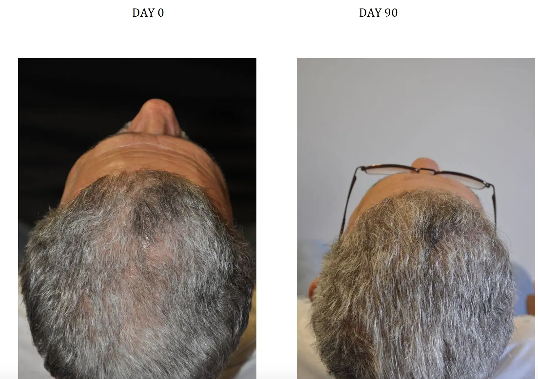 Before and after photos of new hair growth by taking Nanoxidil