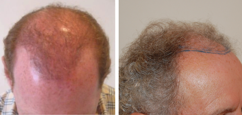 Norwood stage 5 hair loss