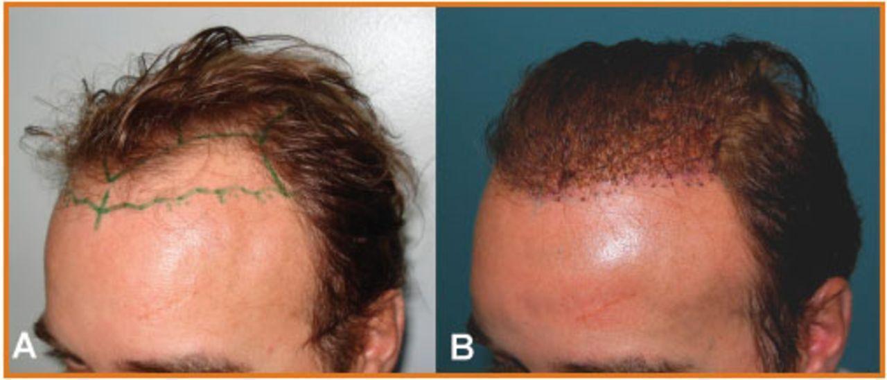 Before and after long hair transplant