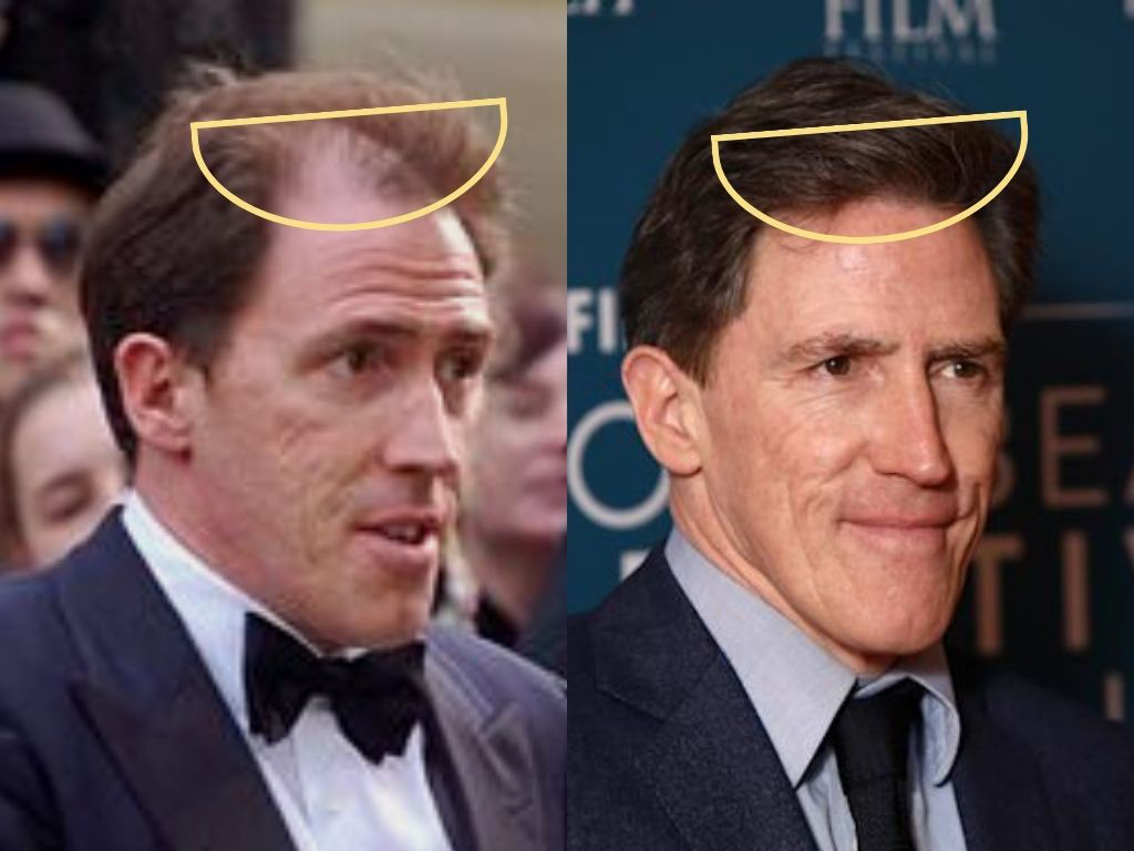 Before and after Rob Brydon hair transplantation