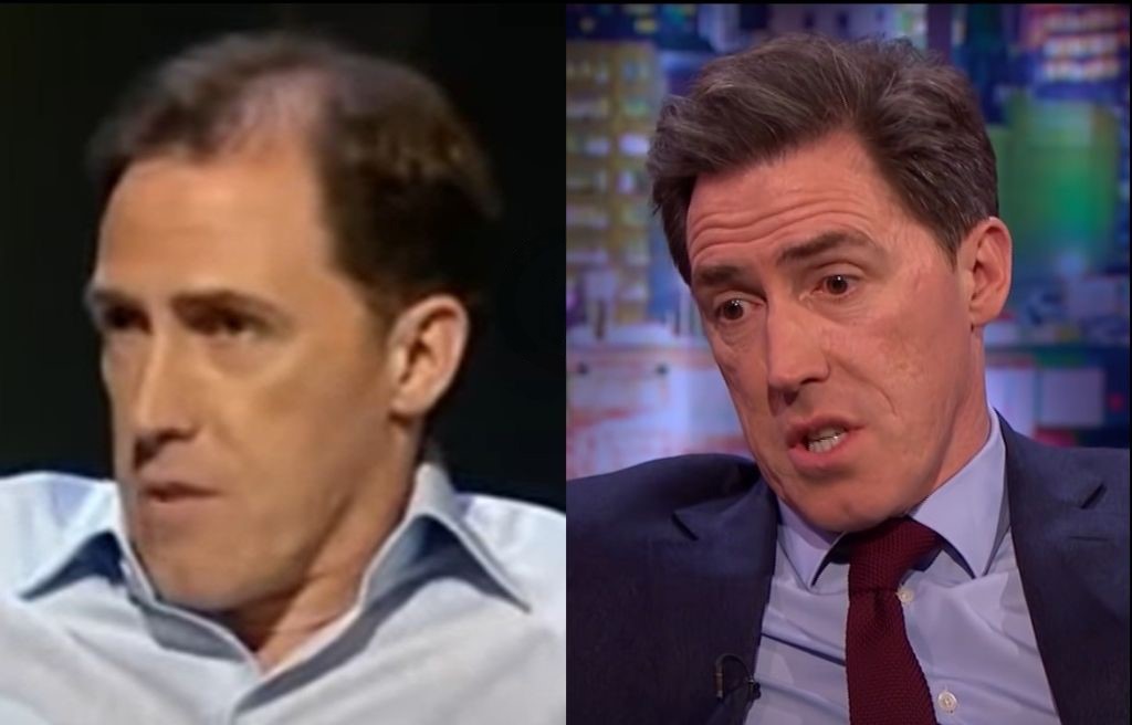 Rob Brydon's hair growth after hair restoration