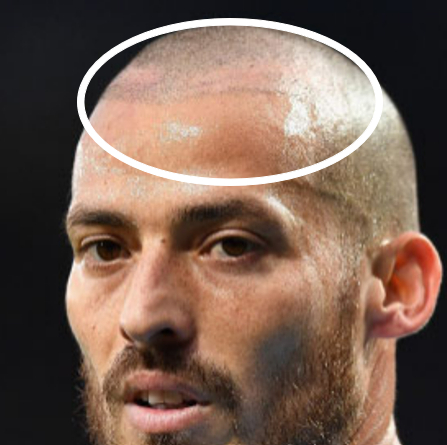 Evidence of David Silva's hair transplantation