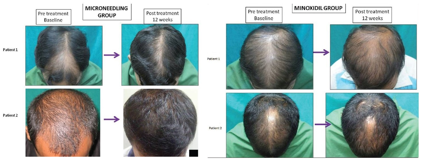 Microneedling vs microneedling and minoxidil
