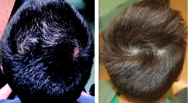 adults with double crown hair