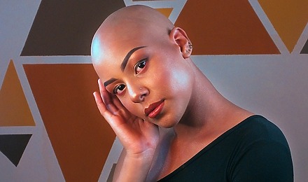 Alopecia Universalis