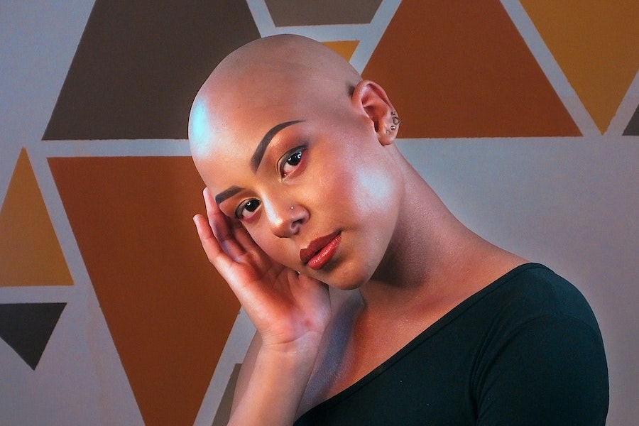 Alopecia Universalis