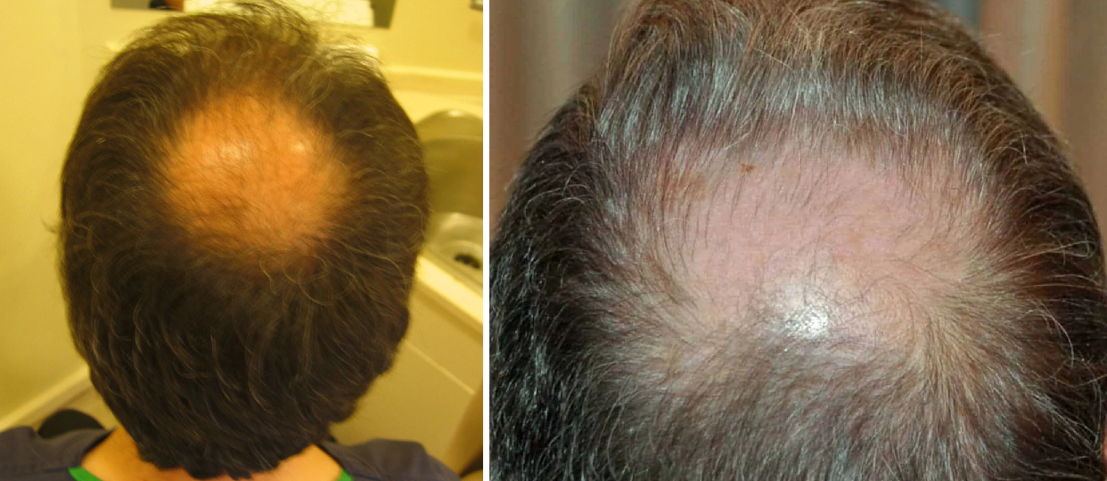 Examples of bald spots on crown due to male pattern hair loss