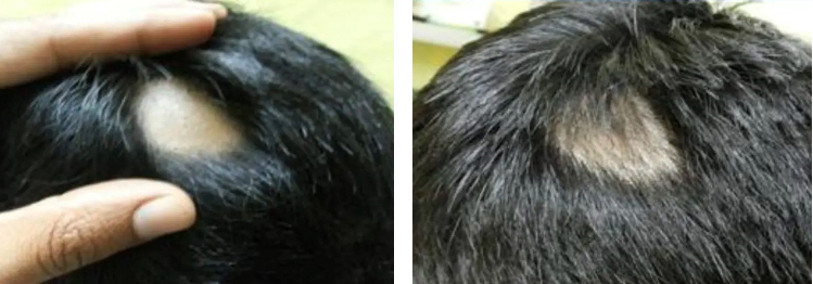 Man before and after 12 weeks of Minoxidil