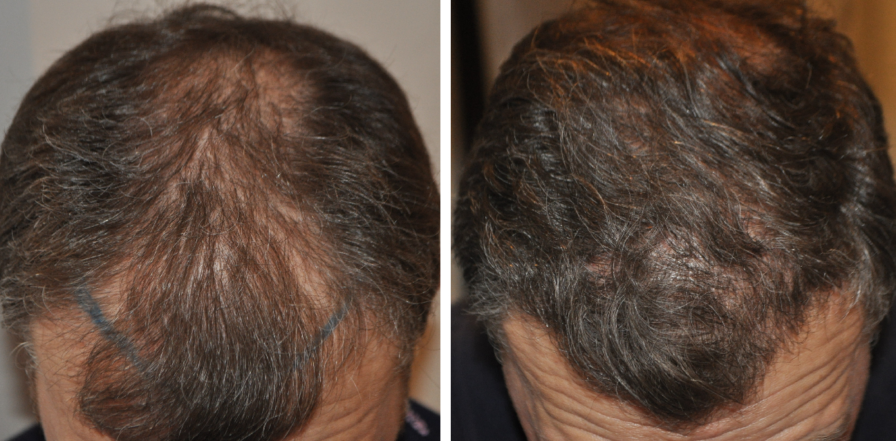 before and after 1600 grafts FUT hair transplant