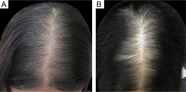 derma rolling for hair growth before and after