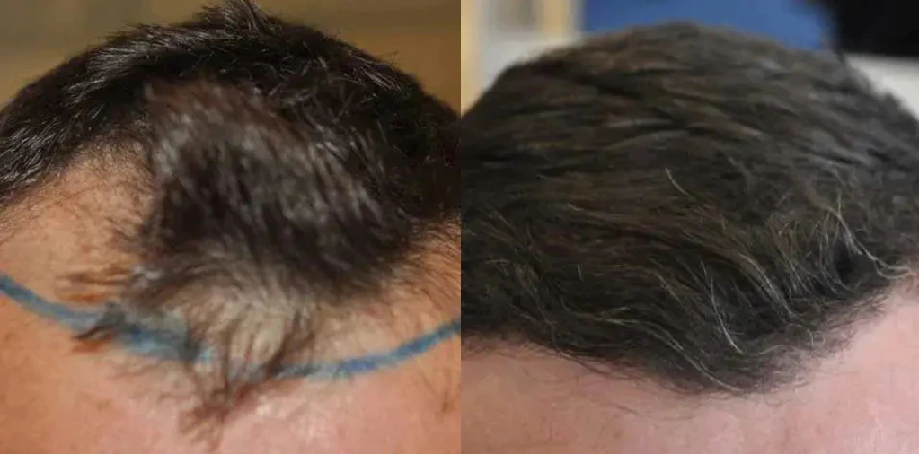 Man before and after a hair transplant at the Wimpole Clinic