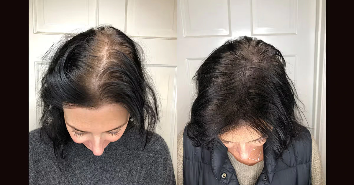 Before and after scalp micropigmentation