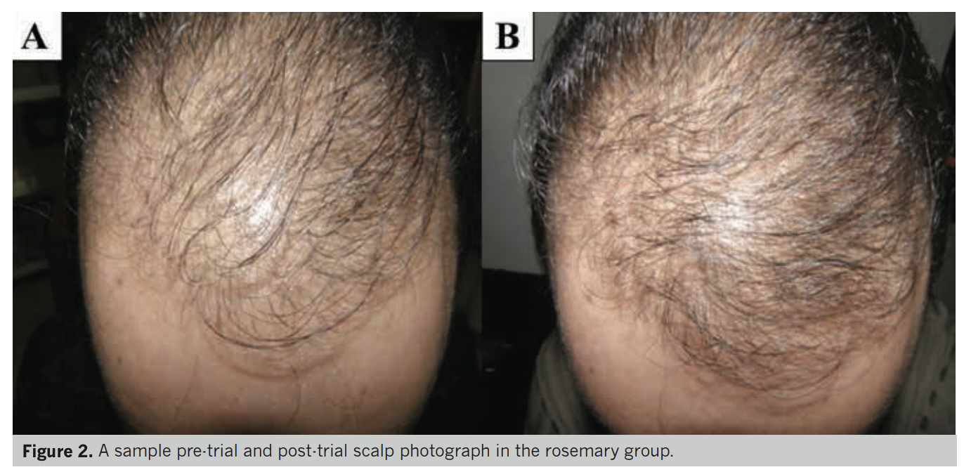 rosemary oil for hair growth before and after