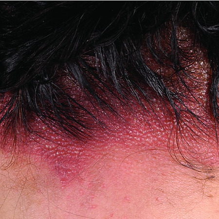 contact dermatitis