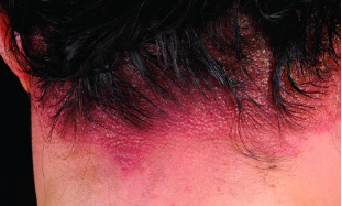 contact dermatitis
