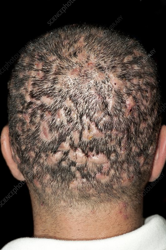 dissecting cellulitis
