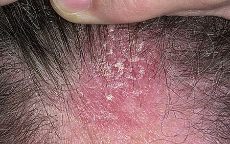 eczema