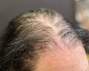 woman with telogen effluvium