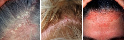 flaky sin, hair loss seborrheic dermatitis, and oily skin from seborrheic dermatitis