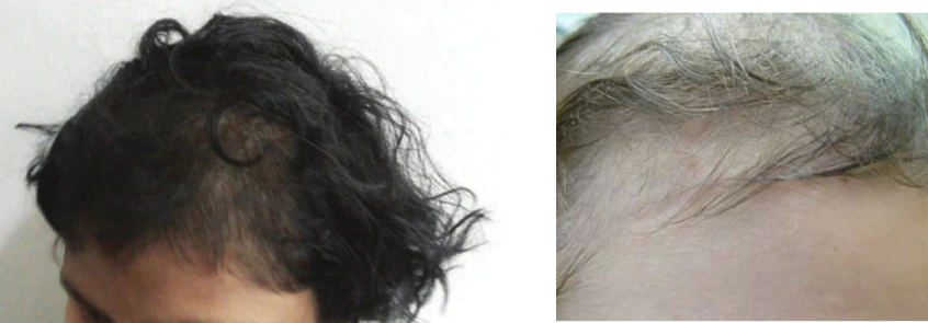Examples of hair loss caused by Trichotillomania