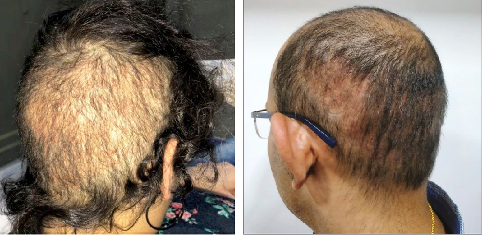 examples of hair loss due to overharvesting from a bad hair transplant