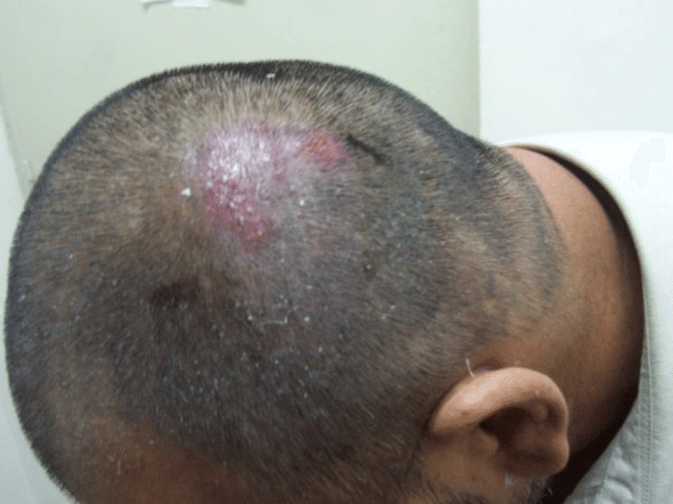 Folliculitis after hair restoration surgery
