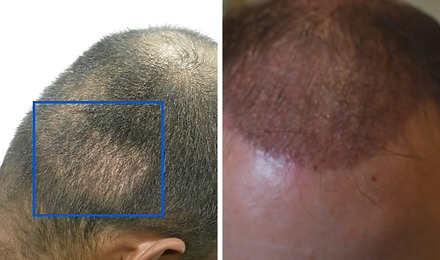 Hair Transplant After 1 Month