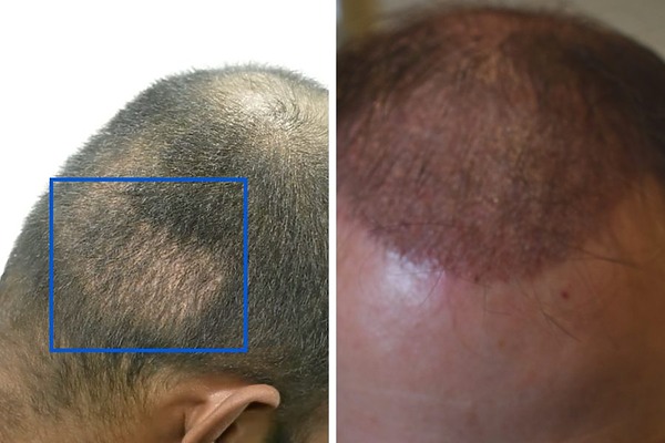 hair transplant after 1 month