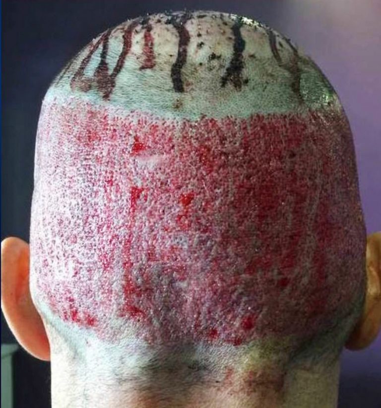 Example of damage to the donor site by extracting too many hair grafts
