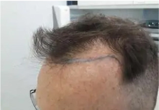 FUE Hair Transplant, Wimpole Clinic