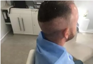FUE Hair Transplant, Wimpole Clinic