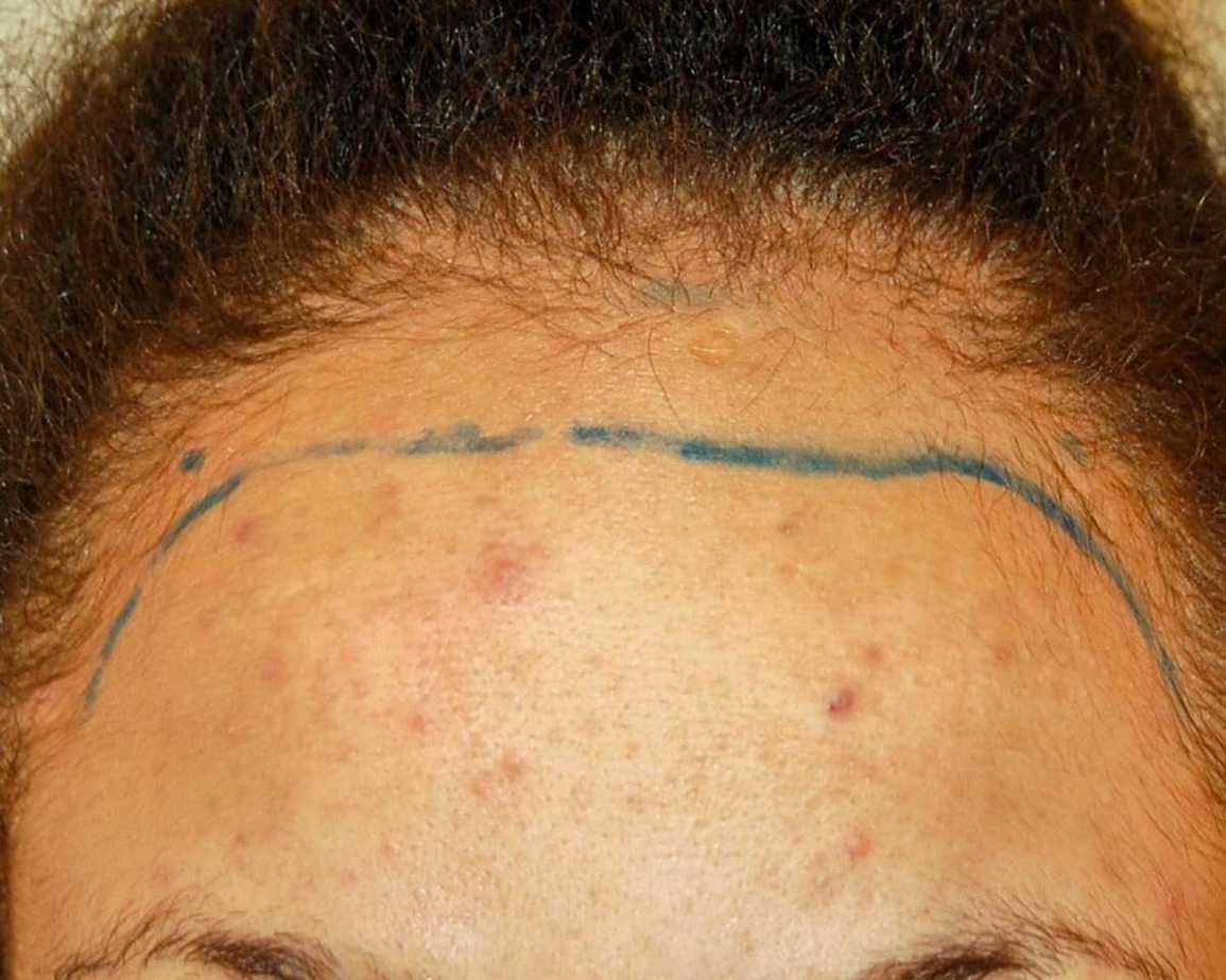 Afro Hair Transplant, Wimpole Clinic