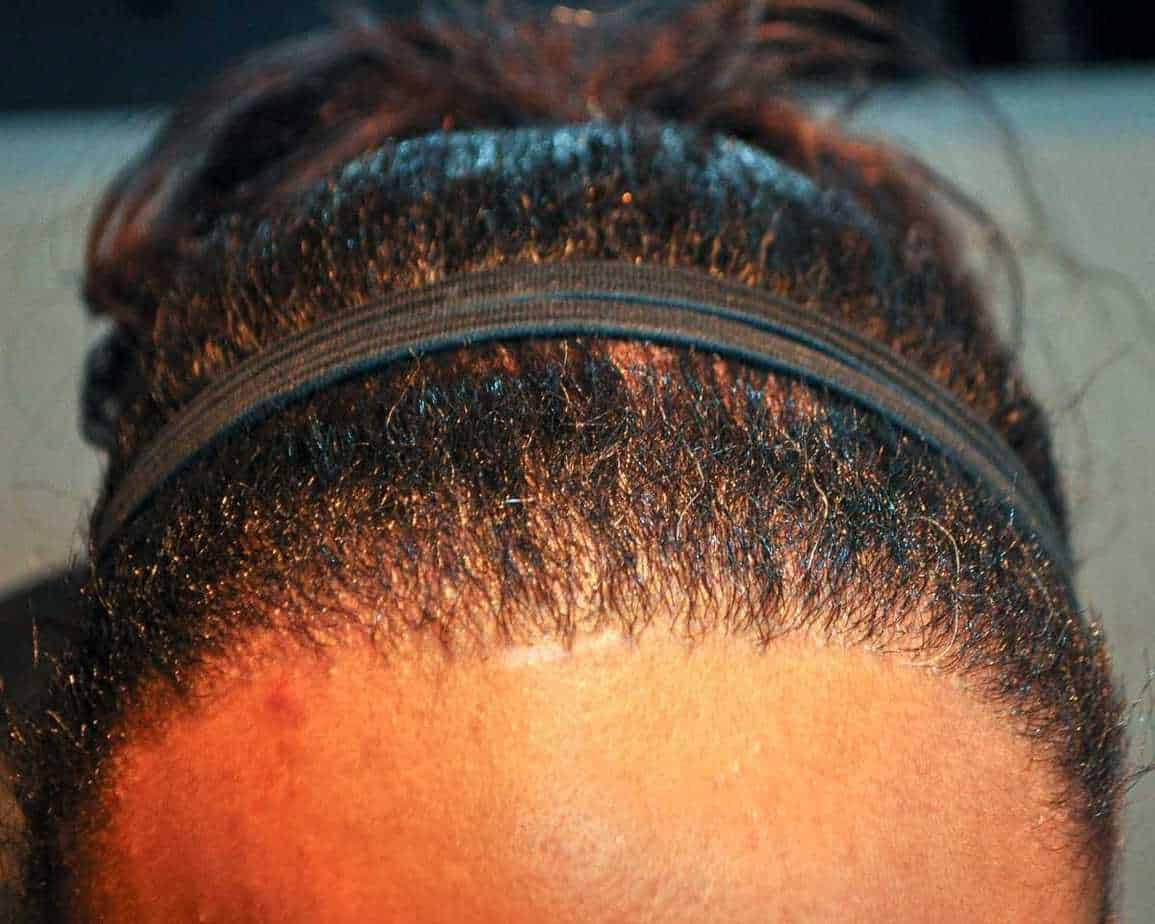 Afro Hair Transplant, Wimpole Clinic