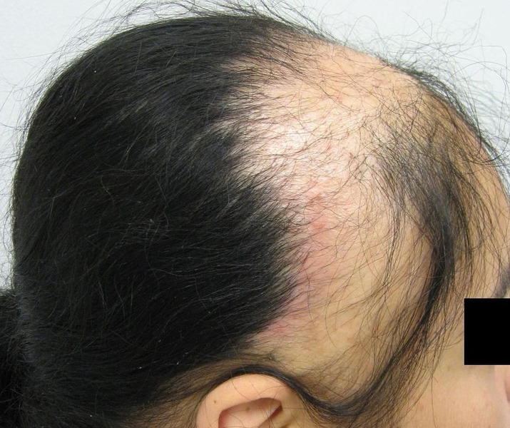 woman with traction alopecia