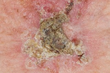 precancerous lesion