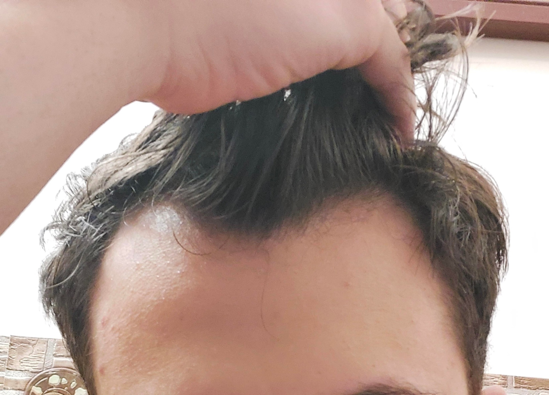Signs and symptoms of early onset hair loss in men