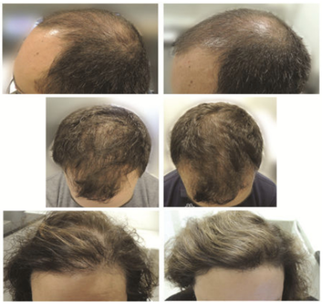 omega-3 for hair growth before and after