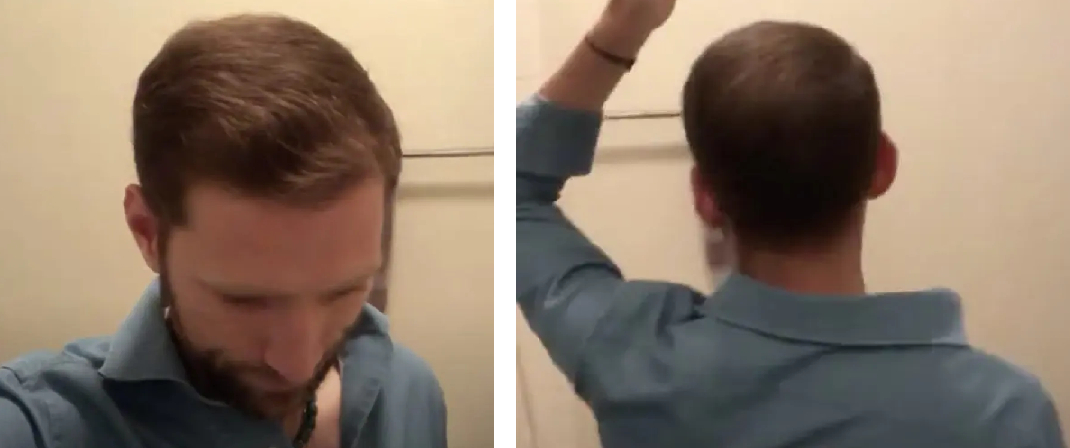 Hair growth results from Finasteride to treat male pattern baldness
