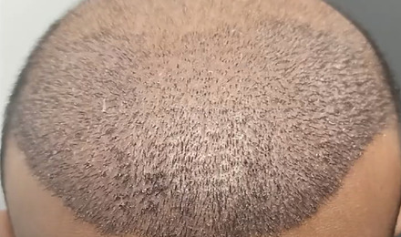 Scalp 10 Days After Hair Transplant Featured Image