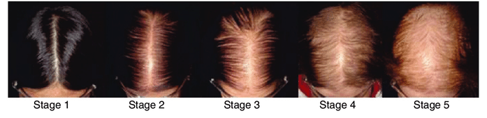 Sinclair scale for female hair loss.