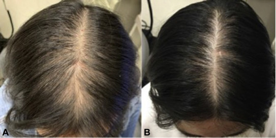Before and after results of using Spironolactone for 6 months