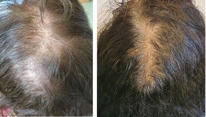 Examples of diffuse hair loss due to telogen effluvium