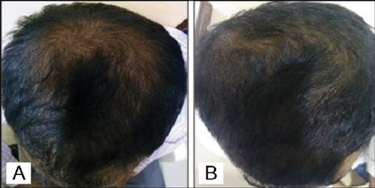 Topical Minoxidil and hair growth: clinical photos after using 5% Minoxidil for 6 months