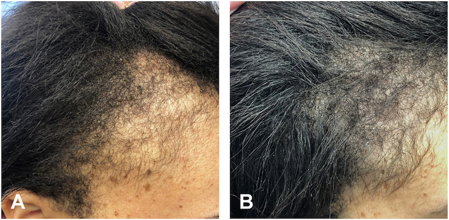 Before and after using Minoxidil to treat hair loss from traction alopecia